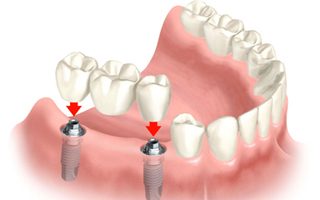 Dental Implants, Best Prosthodontist Gurgaon