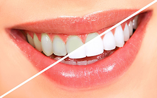 Laser Teeth Whitening, Best Dentist Gurgaon