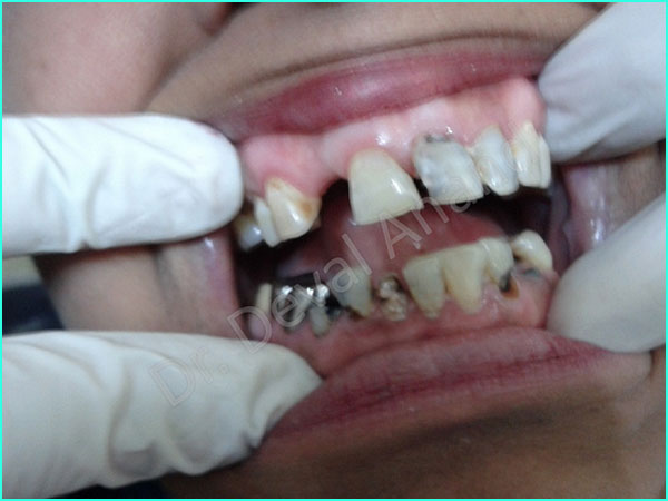 full mouth rehab treatment in gurgaon - 2