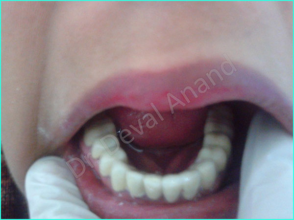 full mouth rehab treatment in gurgaon - 5
